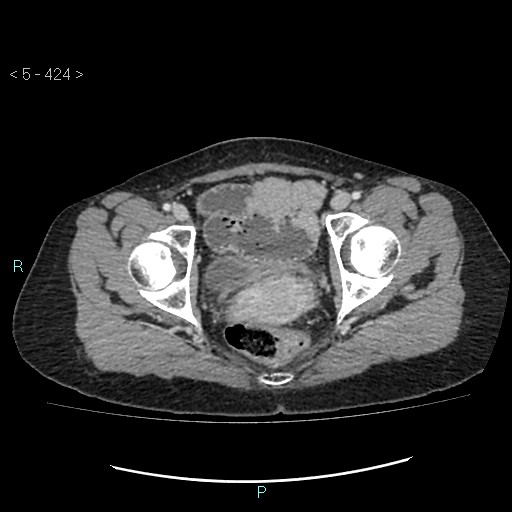 File:Adult transient intestinal intussusception (Radiopaedia 34853-36310 Axial C+ portal venous phase 112).jpg