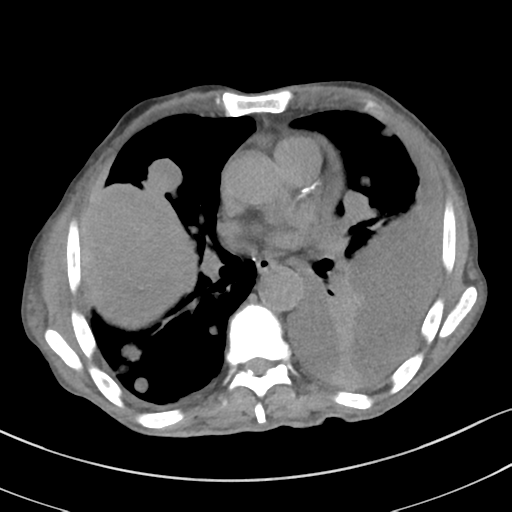 Advanced metastatic lung cancer (Radiopaedia 48910-53954 Axial non-contrast 35).png