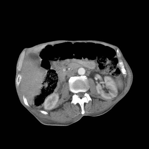 Aggressive lung cancer with cardiac metastases, pulmonary artery tumor thrombus, and Budd-Chiari (Radiopaedia 60320-67981 A 67).jpg