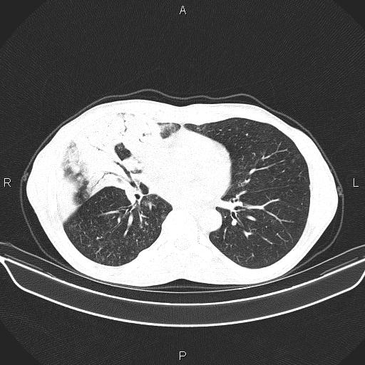 Air bronchogram in pneumonia (Radiopaedia 85719-101512 Axial lung window 38).jpg