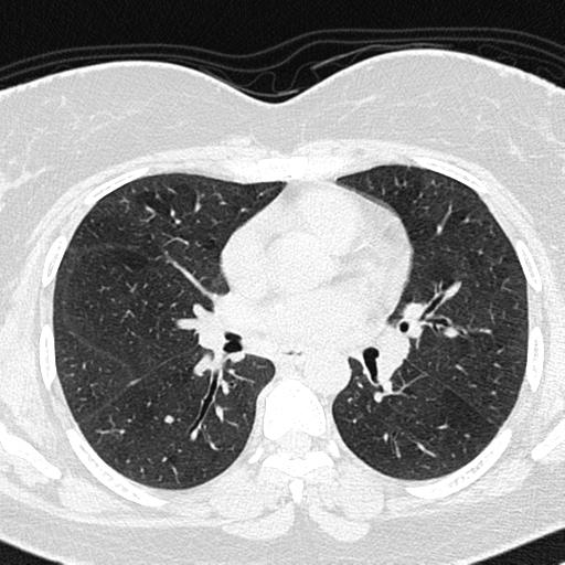 Air trapping in small airway disease (Radiopaedia 61685-69694 Axial lung window 81).jpg