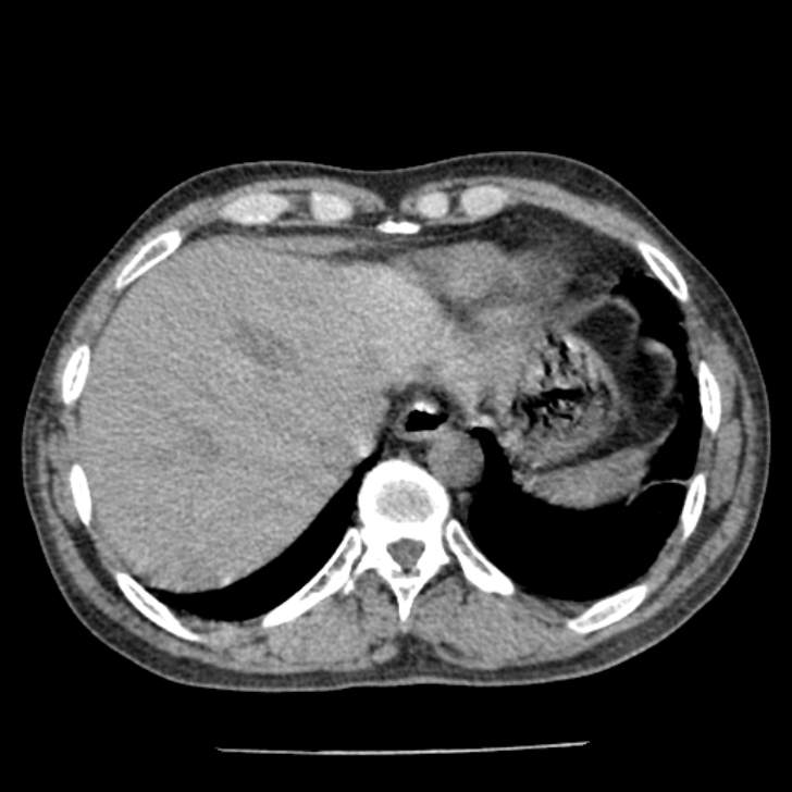 Airway foreign body in adult (Radiopaedia 85907-101779 Axial liver window 165).jpg