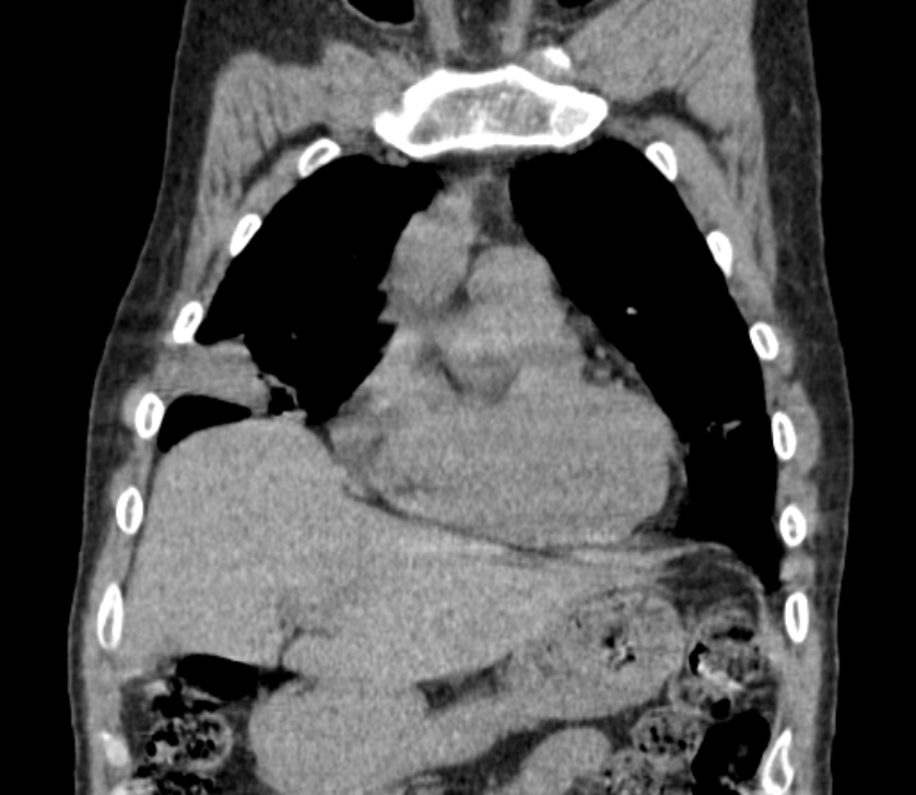 Airway foreign body in adult (Radiopaedia 85907-101779 Coronal liver window 64).jpg