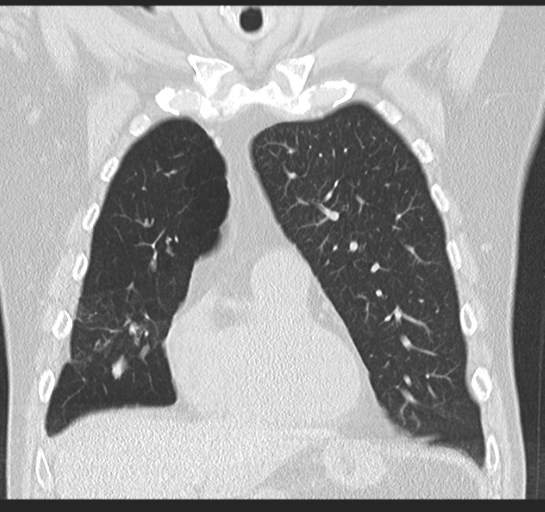 Allergic bronchopulmonary aspergillosis (Radiopaedia 44760-48571 Coronal lung window 20).png