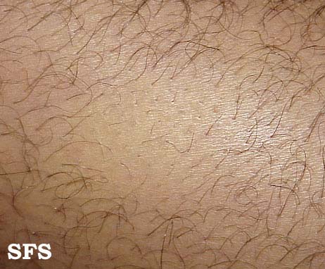 Alopecia Areata (Dermatology Atlas 5).jpg