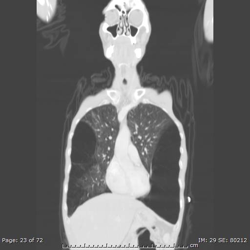 Alpha-1-antitrypsin deficiency (Radiopaedia 50561-55987 Coronal lung window 21).jpg