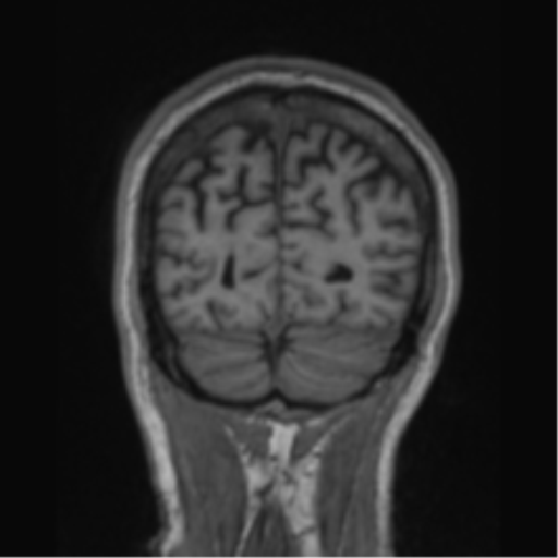 File:Alzheimer's disease- with apraxia (Radiopaedia 54763-61011 Coronal T1 20).png