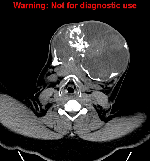 File:Ameloblastoma (Radiopaedia 33126-34164 A 20).jpg