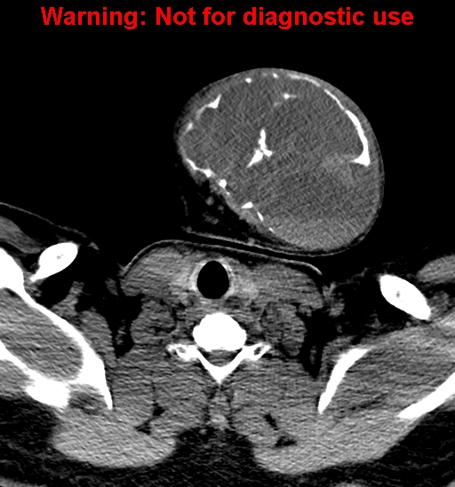 File:Ameloblastoma (Radiopaedia 33126-34164 A 31).jpg