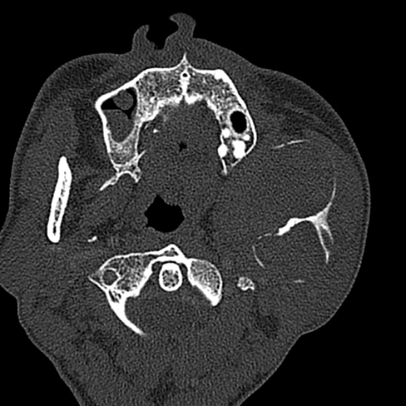 Ameloblastoma (Radiopaedia 51921-57766 Axial bone window 106).jpg