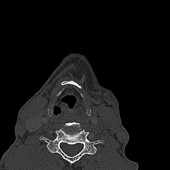 Ameloblastoma (Radiopaedia 51921-57766 Axial bone window 3).jpg