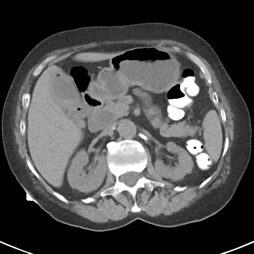 File:Ampullary adenocarcinoma (Radiopaedia 34013-35237 Axial non-contrast 19).png
