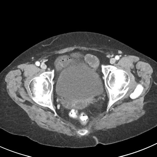 Ampullary adenocarcinoma (Radiopaedia 34013-35237 C 53).png