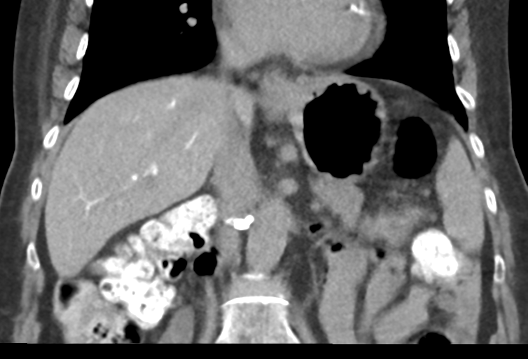 Ampullary adenocarcinoma (Radiopaedia 34013-35241 Coronal 26).png