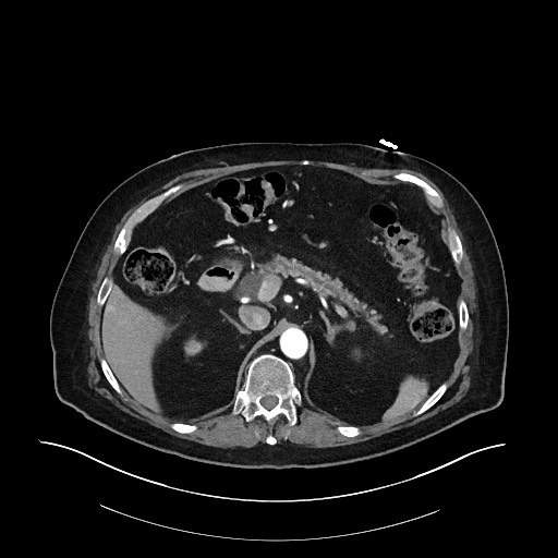 Ampullary adenocarcinoma (Radiopaedia 59373-66734 A 54).jpg
