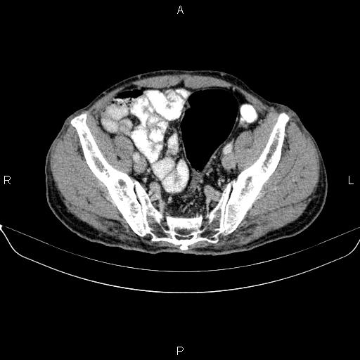 Ampullary adenocarcinoma (Radiopaedia 86093-102032 A 47).jpg