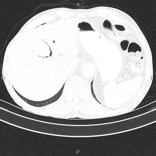 Ampullary adenocarcinoma (Radiopaedia 86093-102033 Axial lung window 52).jpg