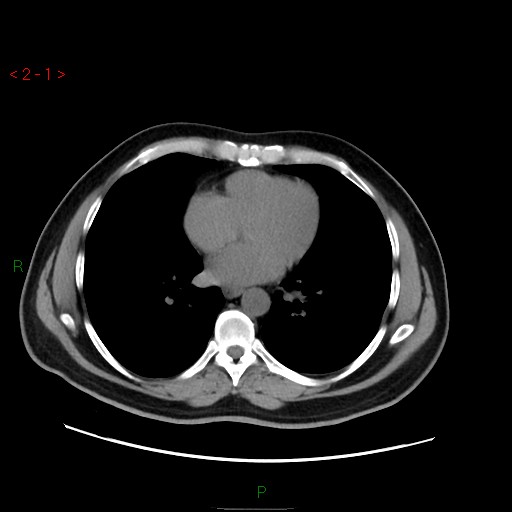 File:Ampullary carcinoma (Radiopaedia 56396-63056 Axial non-contrast 1).jpg