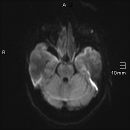 File:Amyotrophic lateral sclerosis (Radiopaedia 70821-81017 Axial DWI 3).jpg