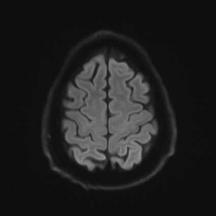 Amyotrophic lateral sclerosis (Radiopaedia 87352-103658 Axial DWI 52).jpg