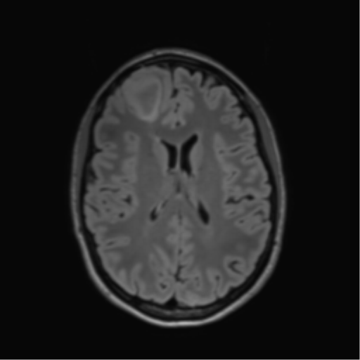 File:Anaplastic astrocytoma IDH mutant (Radiopaedia 50046-55341 Axial FLAIR 30).png