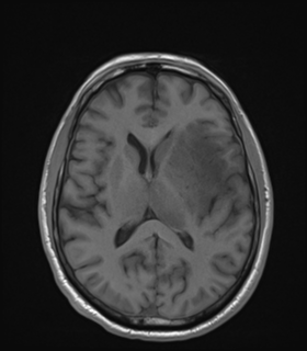 Anaplastic astrocytoma IDH wild-type (Radiopaedia 49984-55273 Axial T1 32).png