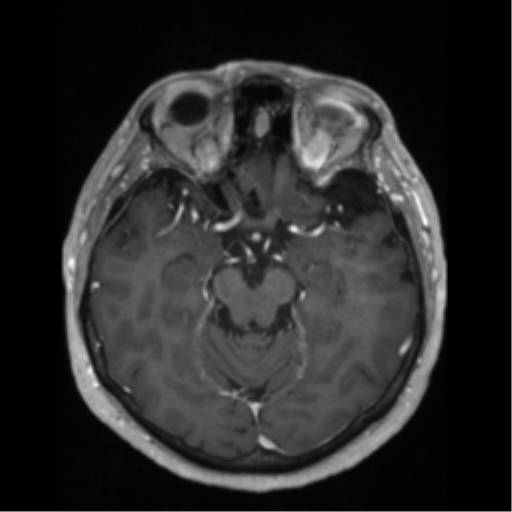 File:Anaplastic astrocytoma IDH wild-type (pseudoprogression) (Radiopaedia 42209-45276 Axial T1 C+ 61).png