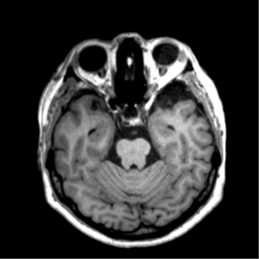 File:Anaplastic astrocytoma IDH wild-type (pseudoprogression) (Radiopaedia 42209-45277 Axial T1 46).png