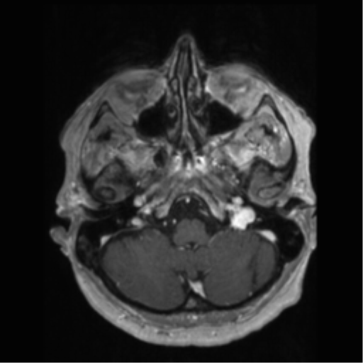 File:Anaplastic astrocytoma IDH wild-type (pseudoprogression) (Radiopaedia 42209-45277 Axial T1 C+ 19).png