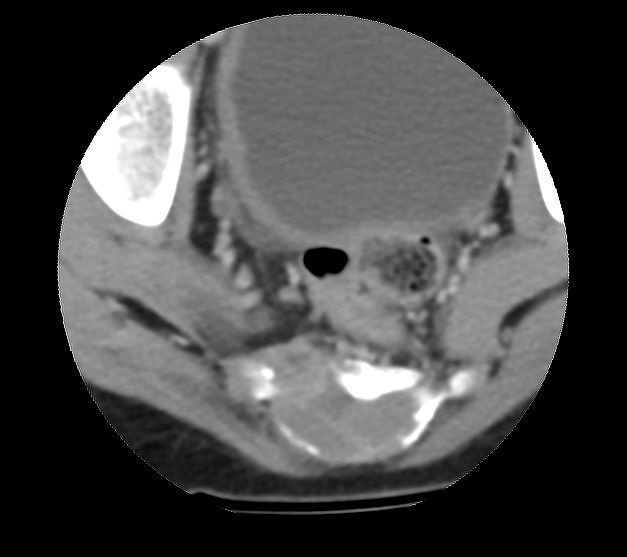 Aneurysmal bone cyst - sacrum (Radiopaedia 65190-74195 Axial non-contrast 36).jpg