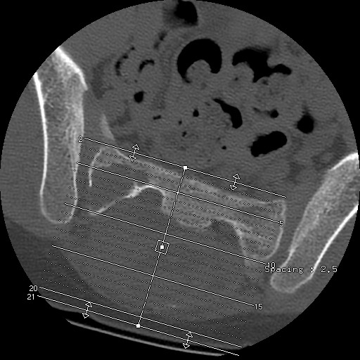 File:Aneurysmal bone cyst - sacrum (Radiopaedia 65190-74195 Coronal bone window 1).jpg