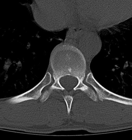 Aneurysmal bone cyst T11 (Radiopaedia 29294-29721 Axial bone window 29).jpg