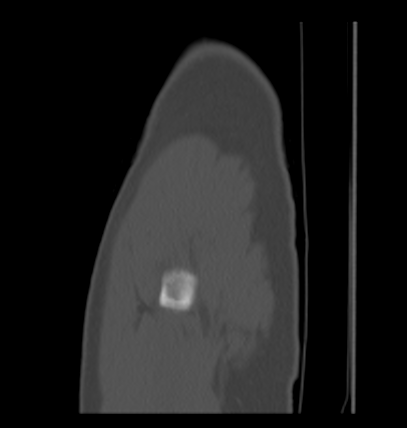 Aneurysmal bone cyst of ischium (Radiopaedia 25957-26094 Sagittal bone window 3).png