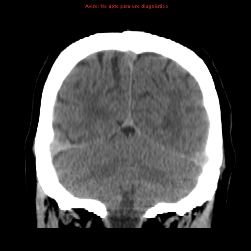 File:Aneurysmal subarachnoid hemorrhage (Radiopaedia 24740-24997 Coronal non-contrast 39).jpg