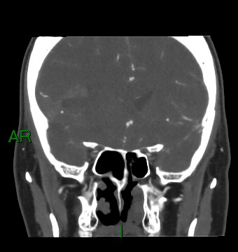 Aneurysmal subarachnoid hemorrhage with intra-axial extension (Radiopaedia 84371-99732 C 66).jpg