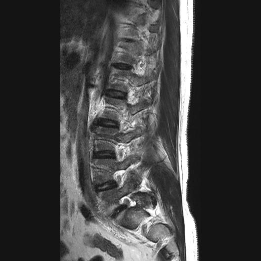 File:Ankylosing spondylitis with zygapophyseal arthritis (Radiopaedia 38433-40516 Sagittal T2 9).jpg