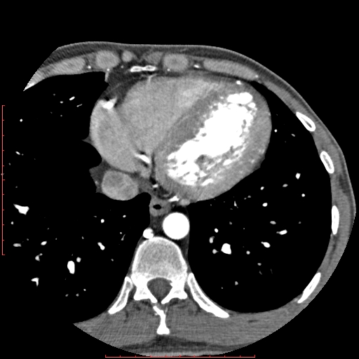 Anomalous left coronary artery from the pulmonary artery (ALCAPA) (Radiopaedia 70148-80181 A 286).jpg
