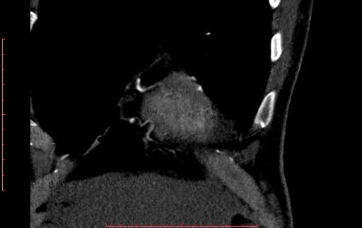 Anomalous left coronary artery from the pulmonary artery (ALCAPA) (Radiopaedia 70148-80181 B 44).jpg