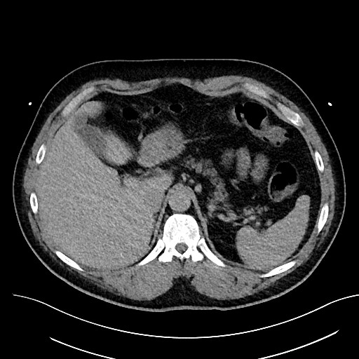 File:Anomalous origin of the left coronary artery with malignant course (Radiopaedia 77842-90126 Axial non-contrast 34).jpeg