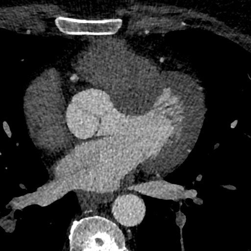 File:Anomalous origin of the left coronary artery with malignant course (Radiopaedia 77842-90126 C 108).jpeg