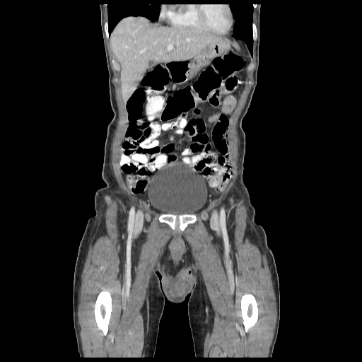 Anorectal carcinoma (Radiopaedia 44413-48064 B 10).jpg