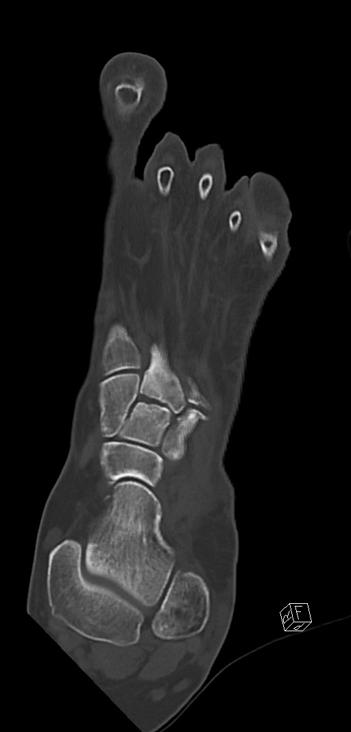Anterior calcaneal process fracture (Radiopaedia 63353-71943 Coronal bone window 17).jpg