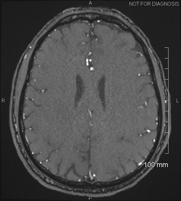 Anterior cerebral artery aneurysm (Radiopaedia 80683-94127 Axial MRA 167).jpg