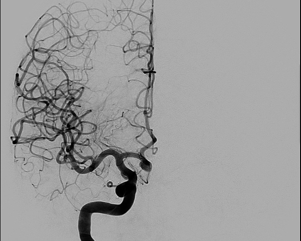 File:Anterior cerebral artery aneurysm (Radiopaedia 80683-94128 A 2).jpg