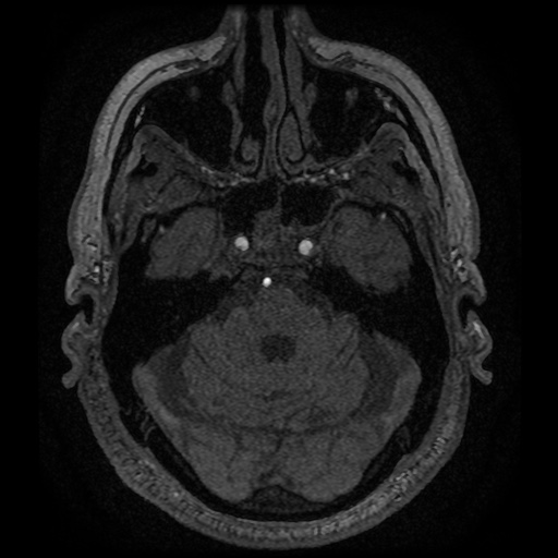 Anterior cerebral artery infarction (Radiopaedia 46794-51323 Axial MRA 35).jpg