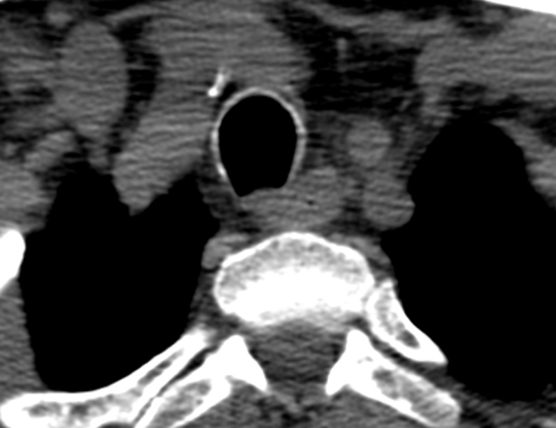 Anterior cervical postdiscectomy arthrodesis (Radiopaedia 32678-33646 Axial non-contrast 73).jpg
