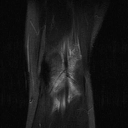 File:Anterior cruciate ligament avulsion fracture (Radiopaedia 24710-24974 Coronal STIR 12).jpg