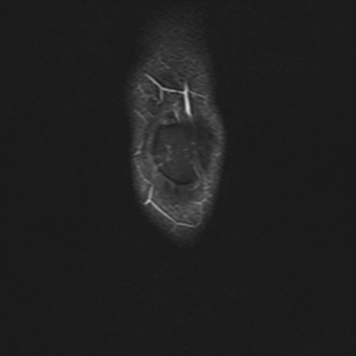 File:Anterior cruciate ligament full thickness tear (Radiopaedia 66268-75467 Coronal STIR 1).jpg