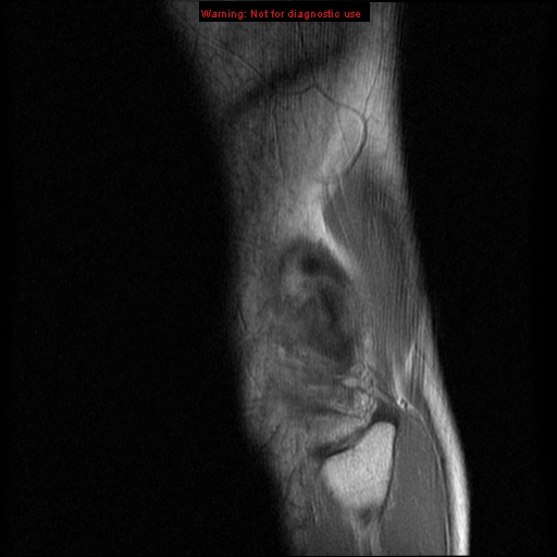 File:Anterior cruciate ligament injury - partial thickness tear (Radiopaedia 12176-12515 Sagittal PD 18).jpg