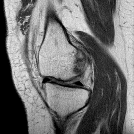 File:Anterior cruciate ligament mucoid degeneration (Radiopaedia 60853-68633 Sagittal PD 13).jpg